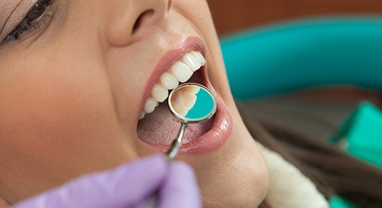 Dentist checking patient's tooth colored filling