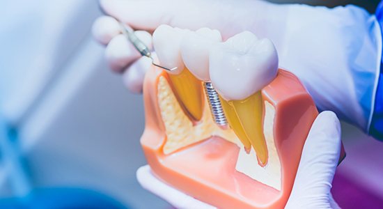 a dentist presenting a model of dental implants