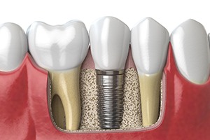 an example of the osseointegration process for dental implants