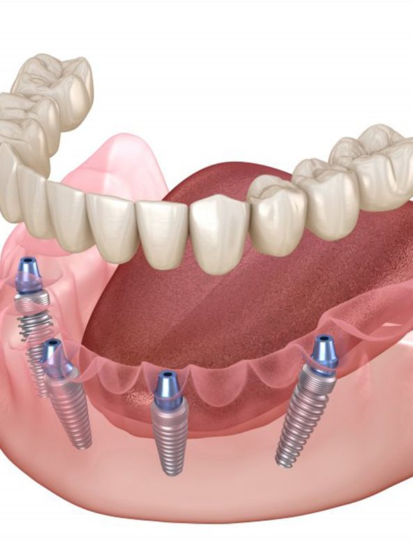 All-on-4 implant dentures