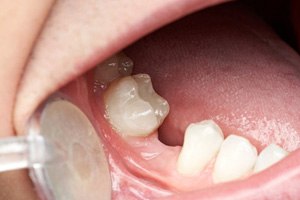 a person with a missing tooth