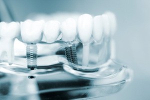 an example of a dental implant bridge