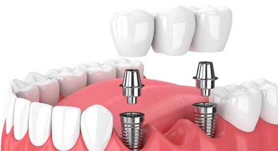 Diagram of a dental bridge in Powell designed for dental implants