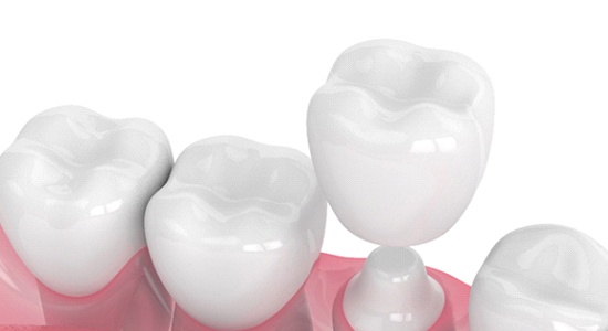 Diagram showing how dental crowns in Powell work