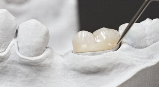Dental crown sitting in a dental mold