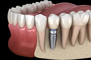 Animated smile with dental implant supported dental crown