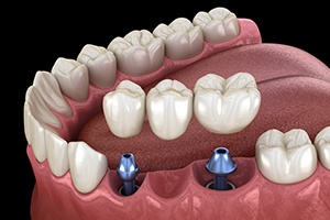 Animated smile with dental implant supported fixed bridge