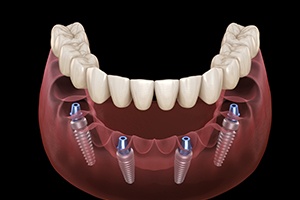 Animated smile with dental implant supported denture