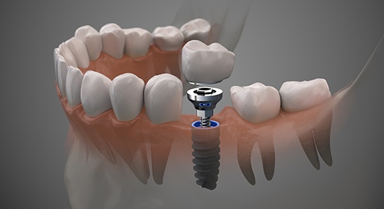 Animated dental implant supported dental crown placement