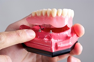 Model dental implant supported denture