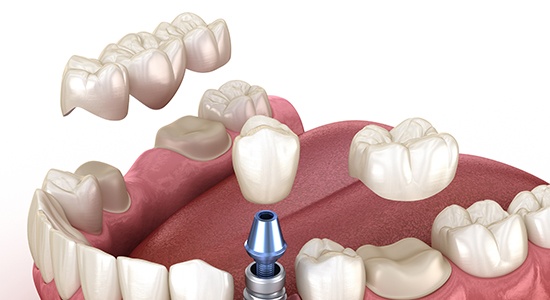 Animated dental implant supported dental crown and fixed bridge tooth replacement options
