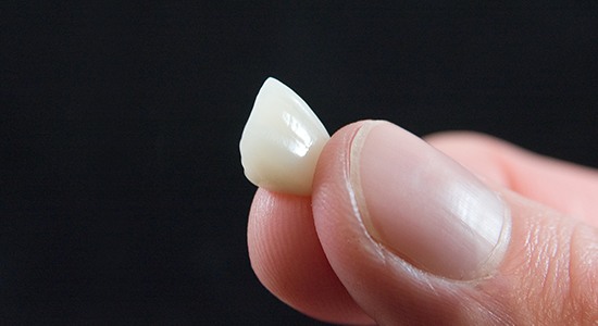 Porcelain veneers sample prior to placement