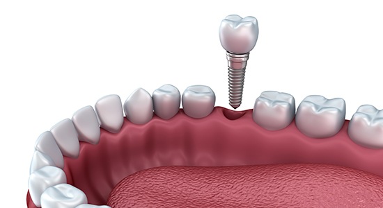 Animated dental implant supported dental crown placement