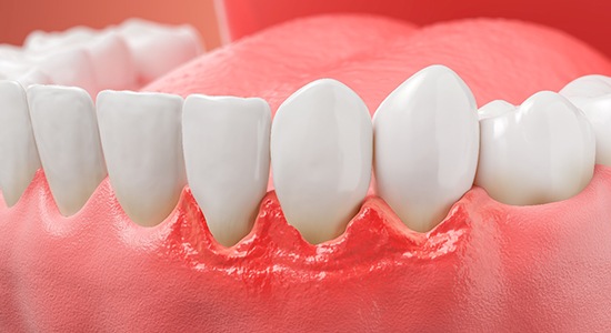 a 3D illustration of gum disease on a gum line