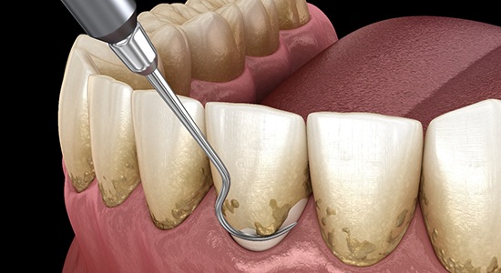 a 3D depiction of scaling and root planing