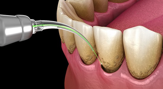 a 3D illustration of laser periodontal treatment