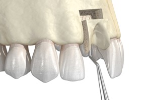 Computer illustration of a bone graft procedure