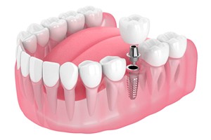 Illustration of implant post, abutment, and crown