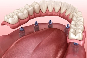 Denture being placed on six implant arches