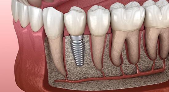 Animated smile with dental implant supported dental crown