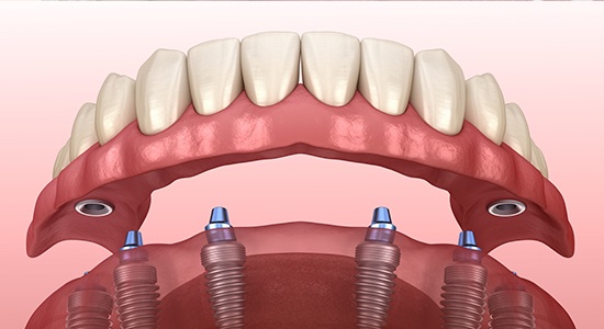 Animated dental implant supported denture placement