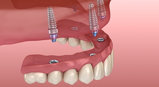 Animated smile during dental implant retained denture placement