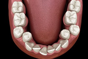 Illustration of crooked teeth