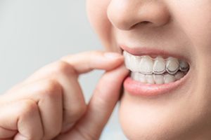 a patient wearing their Invisalign tray