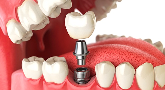 Animated dental implant supported dental crown placement