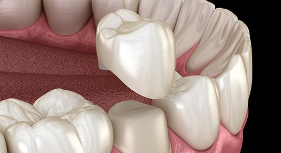 Animated dental crown placement process