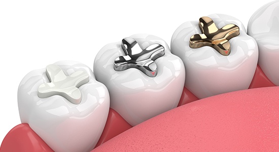 Animated smile with three different types of dental fillings