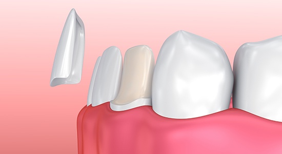 Animated smile during porcelain veneer placement