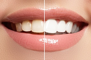 Split image comparing fast in-office and gradual at-home teeth whitening results