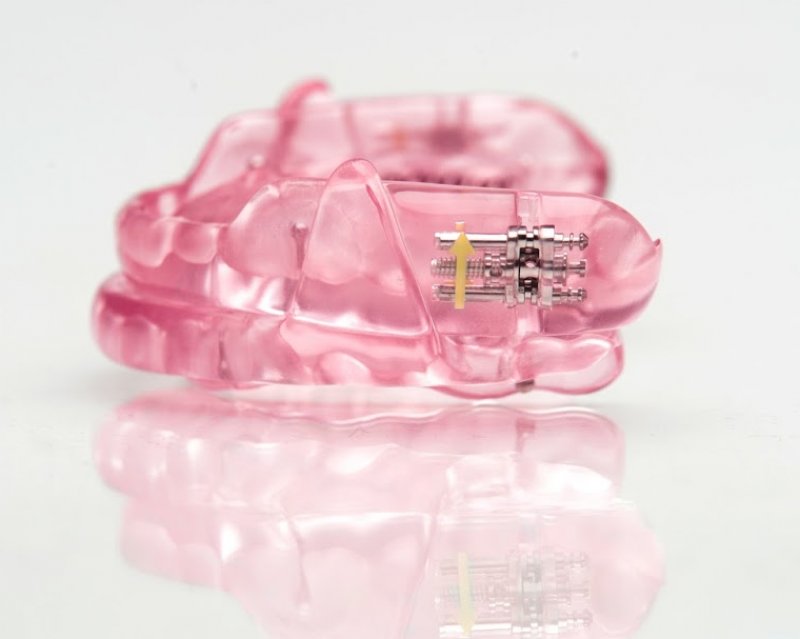 A sleep apnea oral appliance.