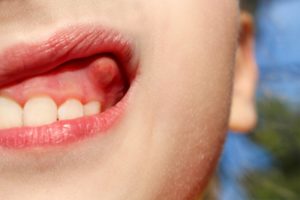 a person showing a bump on their gums